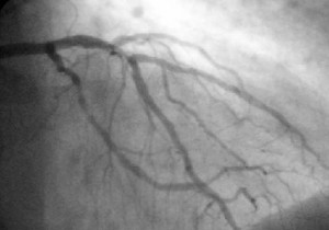 Cardiac catheterization