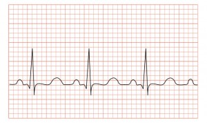 ECG