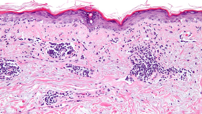 Babies born to mothers with Systemic Lupus Erythematosus are at higher risk of congenital cardiac defects Babies born to mothers with Systemic Lupus Erythematosus are at higher risk of congenital cardiac defects