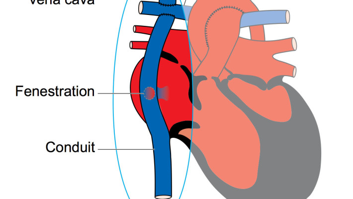 Stimulation of ventricular stiffening trough the different stages of single ventricle surgery leading to the Fontan operation Stimulation of ventricular stiffening trough the different stages of single ventricle surgery leading to the Fontan operation