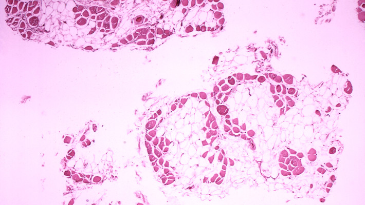 Arrhythmias and cardiac dysfunction in Duchenne and Becker muscular dystrophy Arrhythmias and cardiac dysfunction in Duchenne and Becker muscular dystrophy