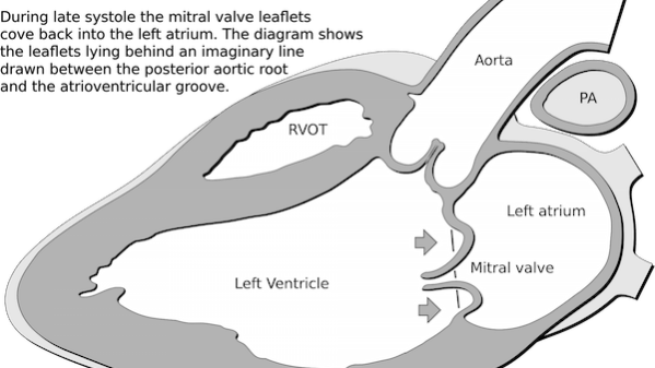 Heart mitral prolapse