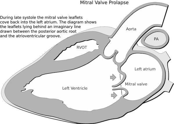 Heart mitral prolapse