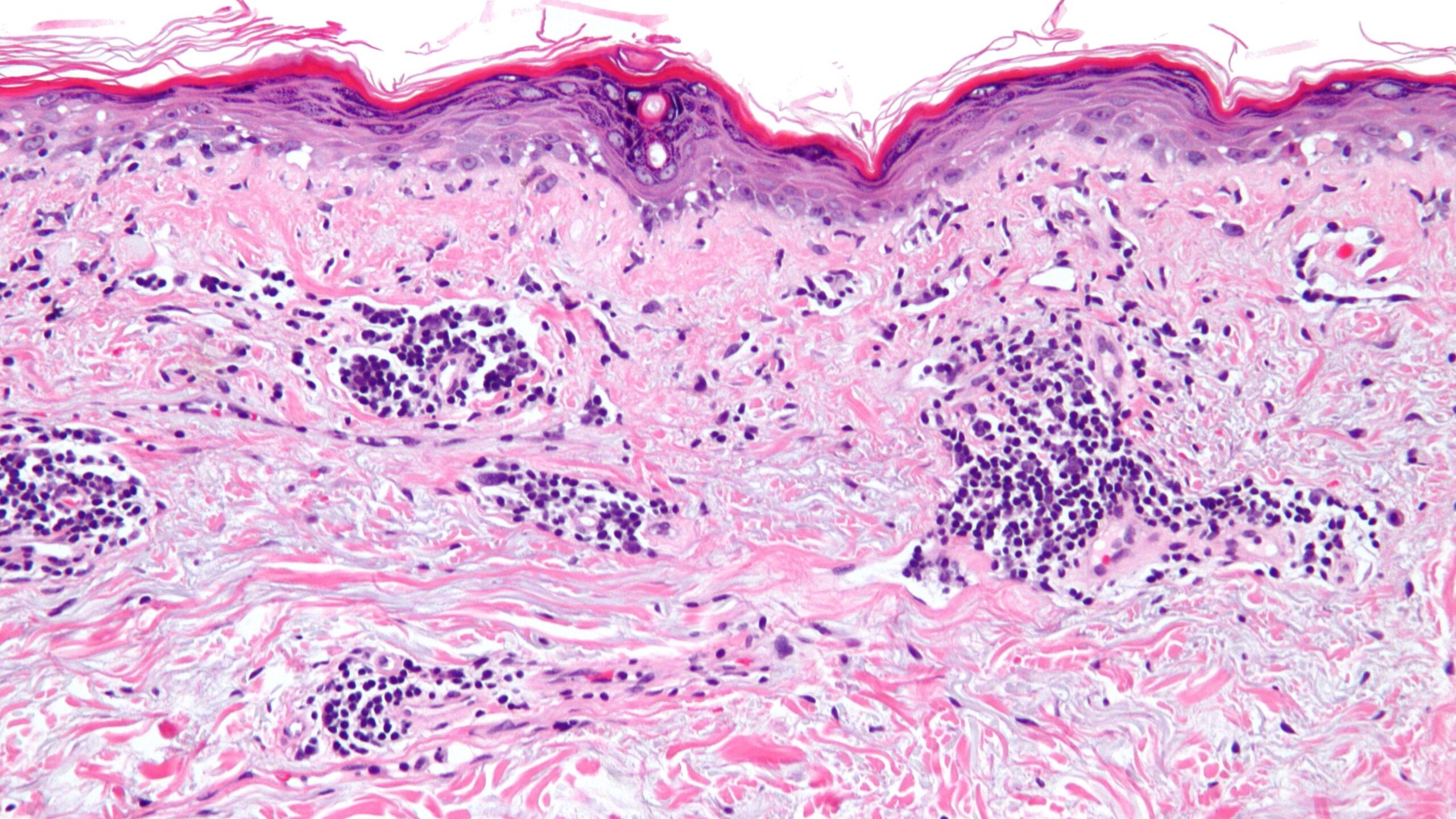 Vacuolar interface dermatitis scaled