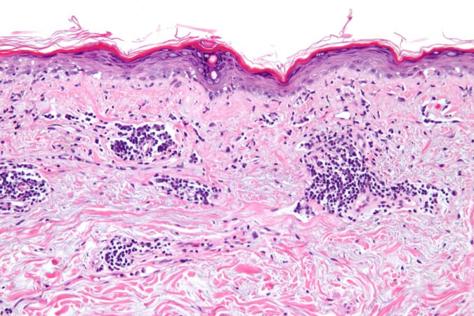 Vacuolar interface dermatitis scaled