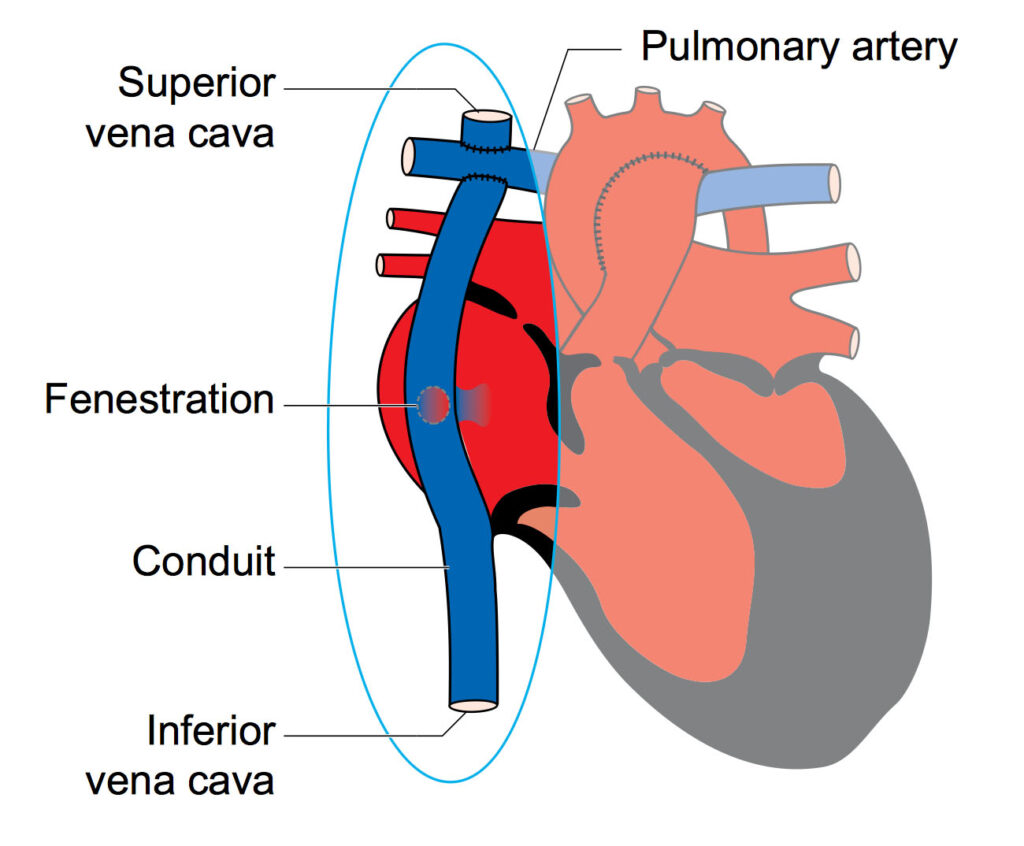 Fontan circulation child heart specialist
