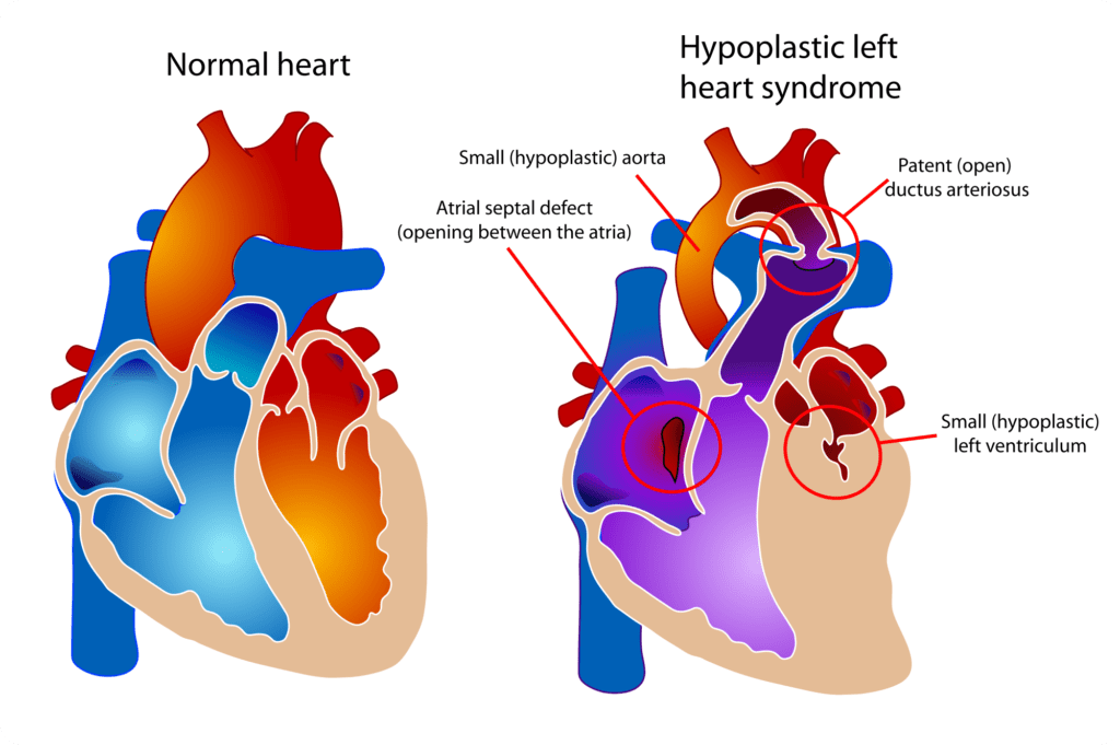 Hypoplastic left heart syndrome child heart specialist london