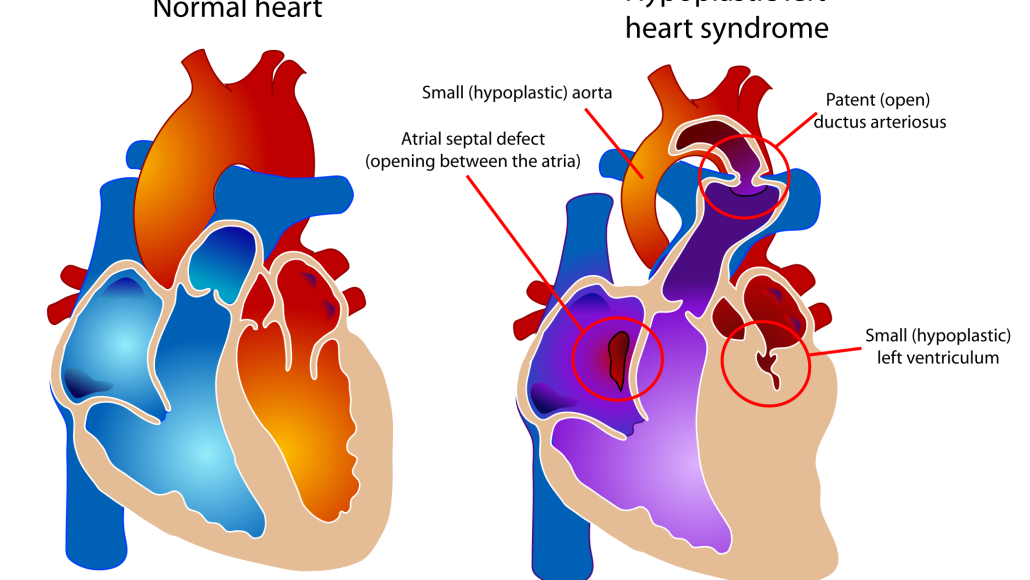 синдром гипоплазии левых отделов сердца. увлечение правого желудочка. расширение левых отделов сердца. дилатационная гипертрофия левого желудочка. расширение левых отделов сердца.