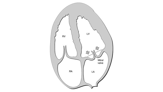 Heart mitral prolapse