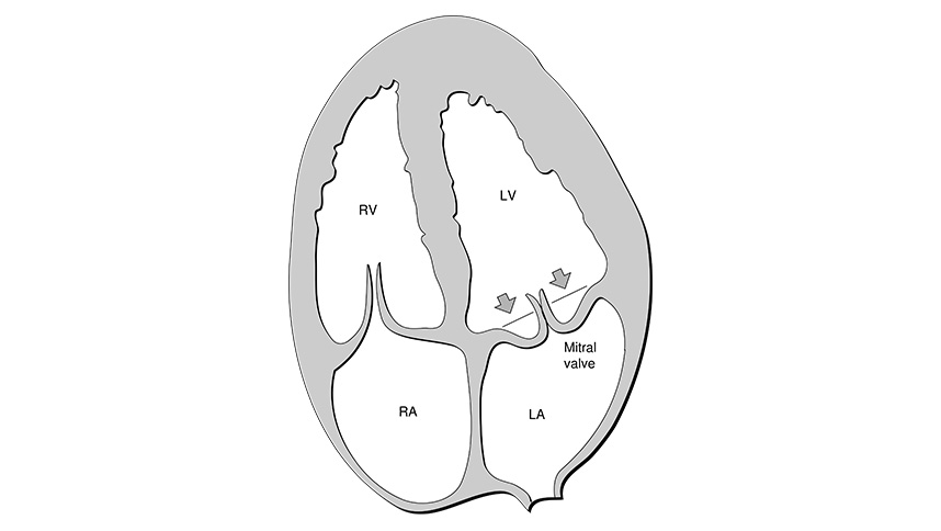 Heart mitral prolapse