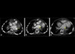 aortopexy pulmonary venous stenosis