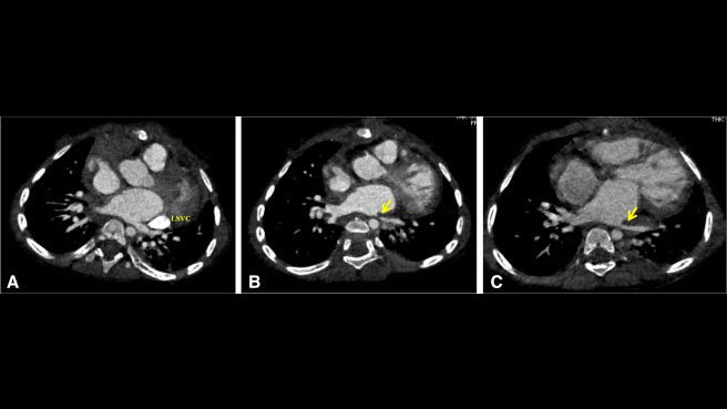 aortopexy pulmonary venous stenosis