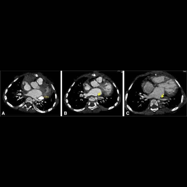 aortopexy pulmonary venous stenosis