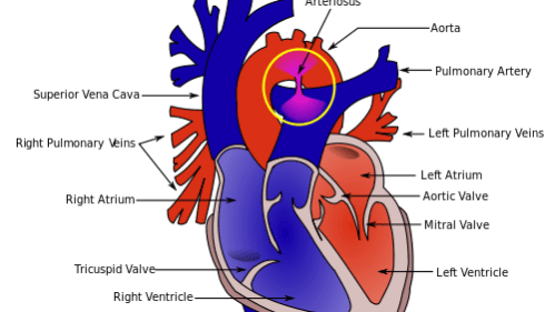 500px Patent ductus arteriosus.svg 