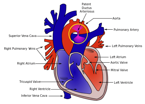 500px Patent ductus arteriosus.svg 