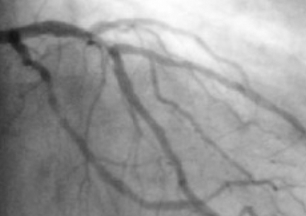 Cardiac catheterization