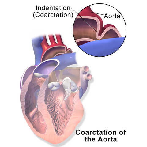 Coarctation of the aorta