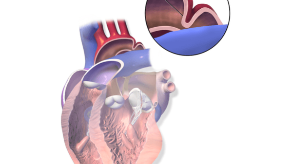Coarctation of the aorta