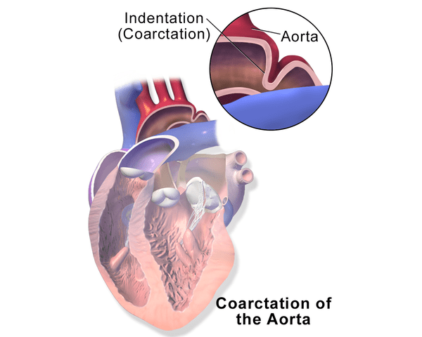 Coarctation of the aorta