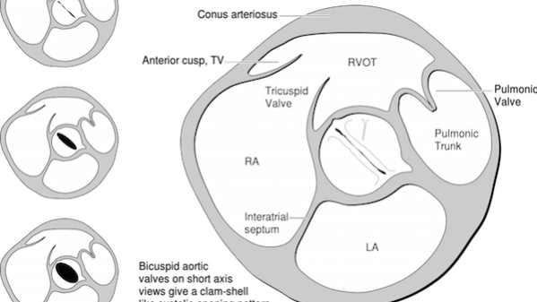 Heart bicuspid aortic valve Heart bicuspid aortic valve