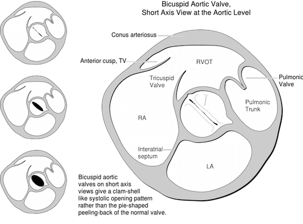 Heart bicuspid aortic valve