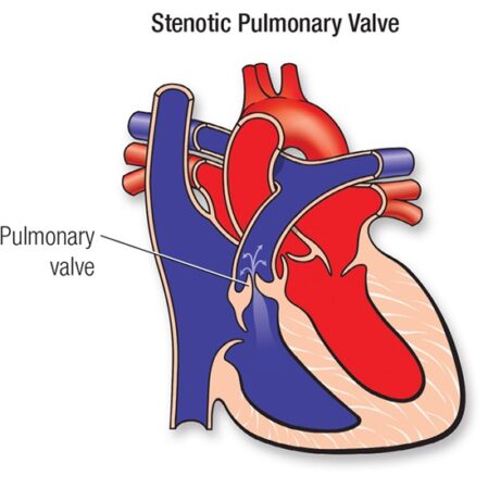Pulmonary stenosis