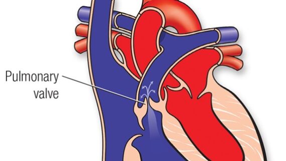 Pulmonary stenosis Pulmonary stenosis