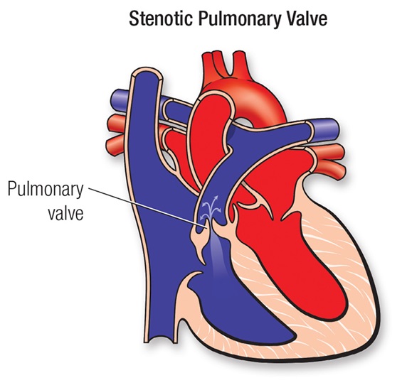 Pulmonary Valve Location