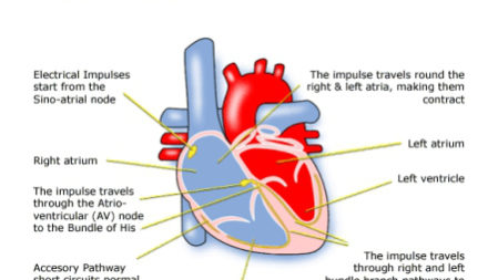 Superventricular Tachycardia Palpitation
