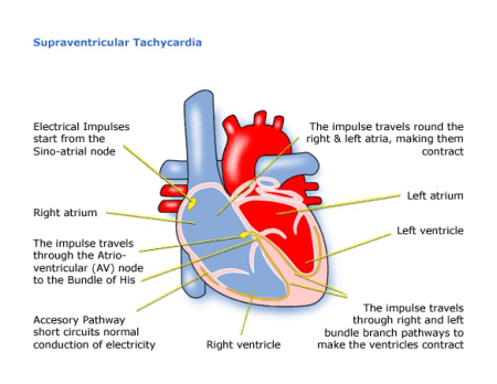 Superventricular Tachycardia Palpitation