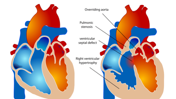 Tetralogy of Fallot