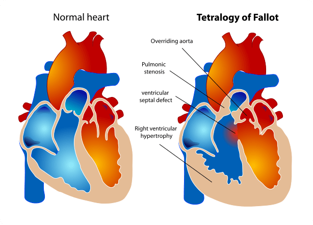 Tetralogy of Fallot