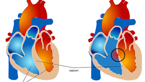 Ventricular septal defect vsd