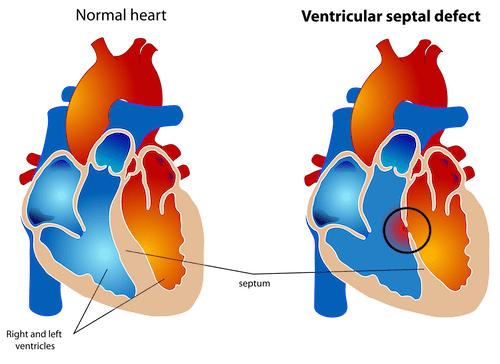 Ventricular septal defect vsd