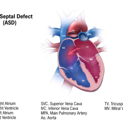 atrial septal defect