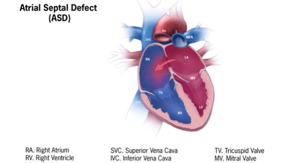 atrial septal defect