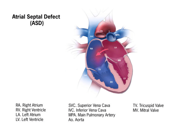 Atrial septal defect (ASD) - Child Heart Specialist