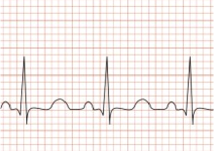 ecg