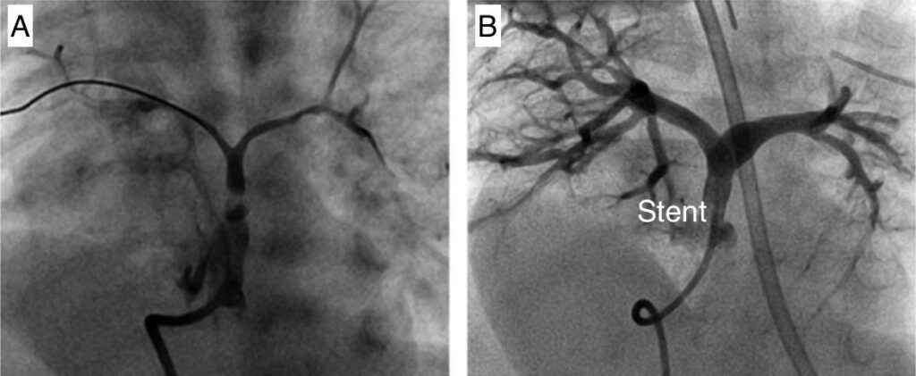 tetralogy of fallot procedure a