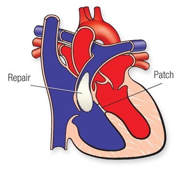 tetralogy of fallot repair