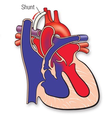 tetralogy of fallot shunt