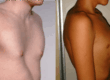 chest wall deformities
