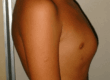 pectus carinatum image