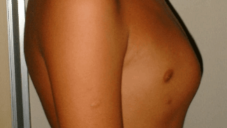 pectus carinatum image