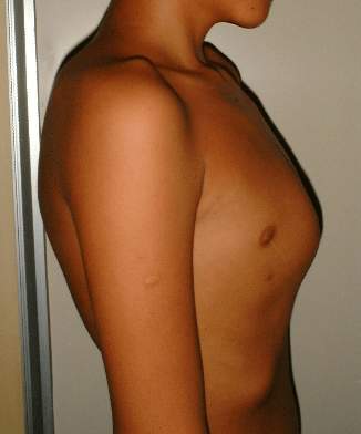 pectus carinatum image