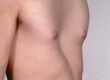pectus excavatum Chest wall deformities
