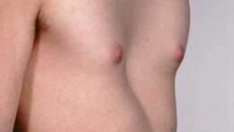 pectus excavatum Chest wall deformities pectus excavatum Chest wall deformities