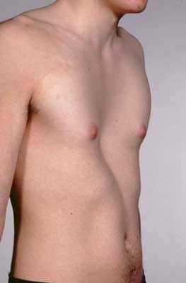 pectus excavatum Chest wall deformities