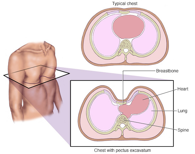 pectus excavatum cardiac assessment