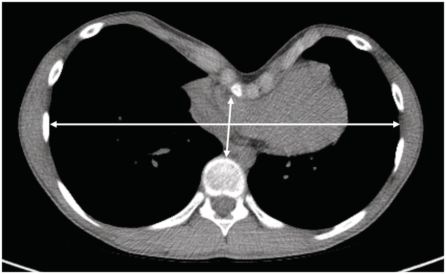 pectus excavatum